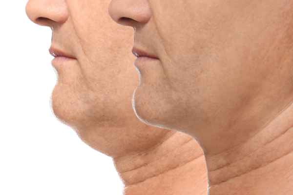 HIFU - Breakthrough in Anti - ageing 2 hifu results Rickmansworth