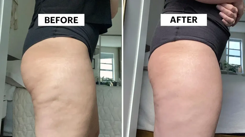 Sculpting Your Bum: Can Toning Exercises Really Reduce Cellulite? 1 Do Toning Exercise Rickmansworth Really Tackle Cellulite?