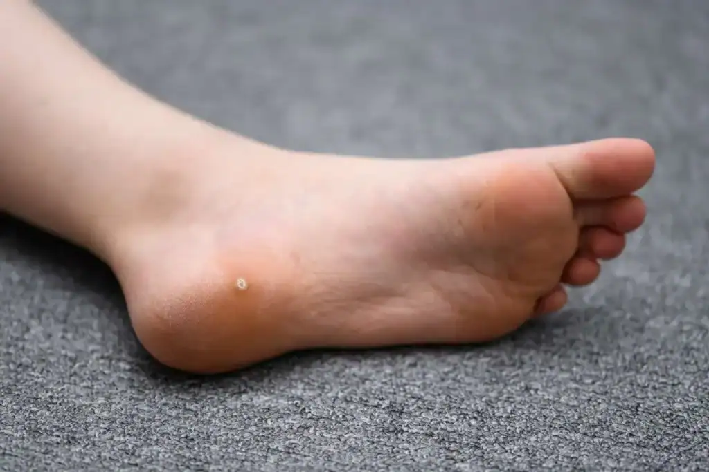 Cryotherapy For Warts And Also Verrucas 2 Image of verruca on the bottom of the foot that able to be treated with Cryotherapy Rickmansworth