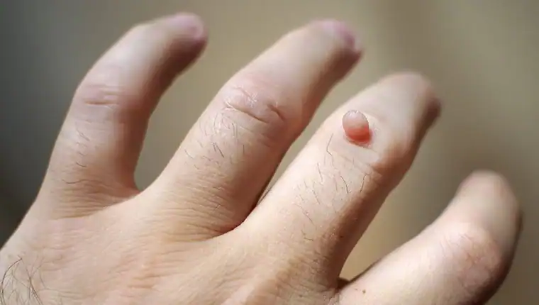 Cryotherapy For Warts And Also Verrucas 1 Image of blemish that Cryotherapy Rickmansworth can remove with Lipo 360.