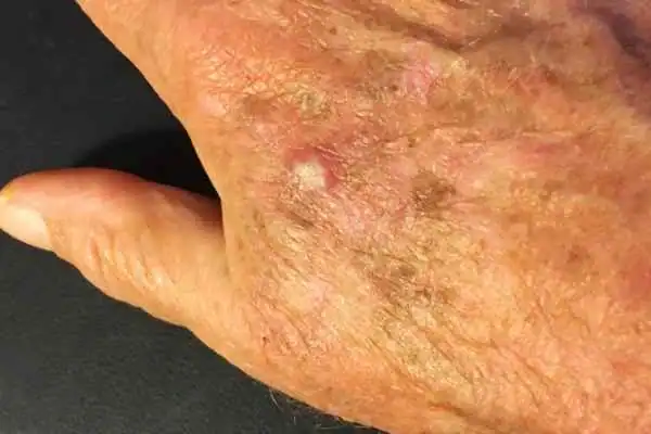 Cryopen For Actinic Keratoses 1 Image of Actinic keratoses Rickmansworth on a person hand