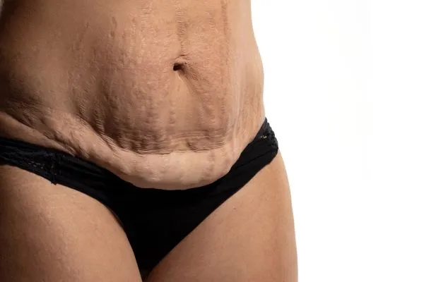 The Science of Skin Tightening 1 The science behind skin tightening Rickmansworth picture of a woman's sagging skin on the stomach